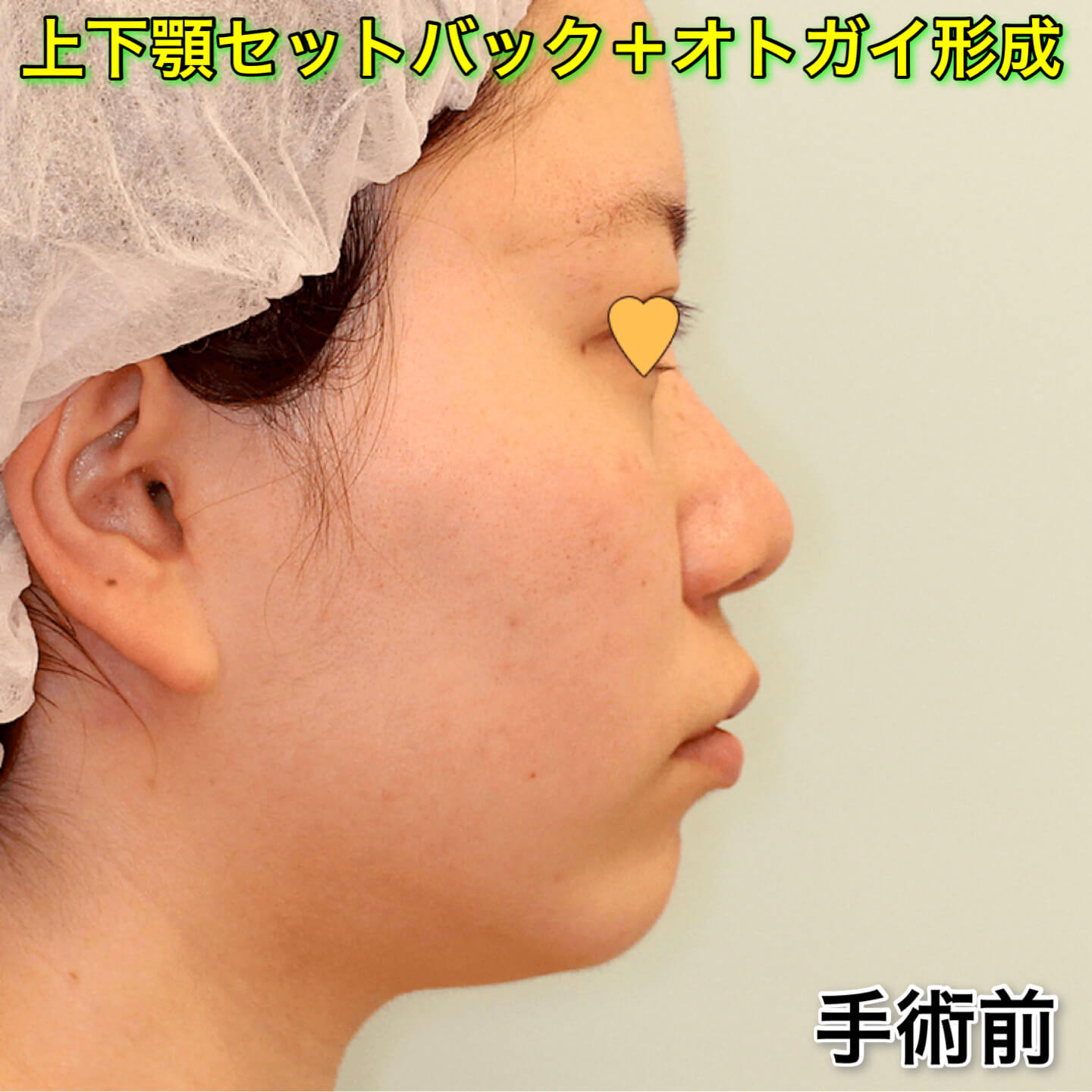 上下顎セットバック+オトガイ形成の症例写真（ビフォーアフター）