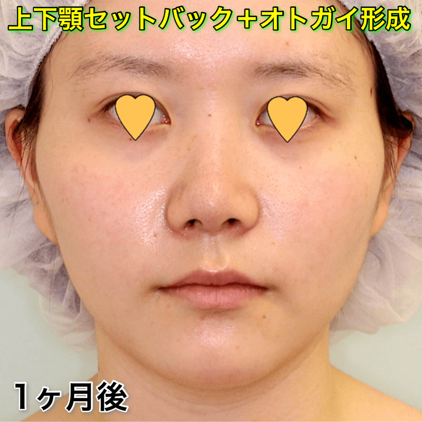 上下顎セットバック+オトガイ形成の症例写真（ビフォーアフター）