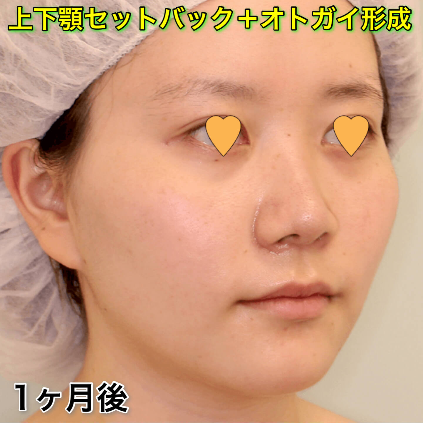 上下顎セットバック+オトガイ形成の症例写真（ビフォーアフター）