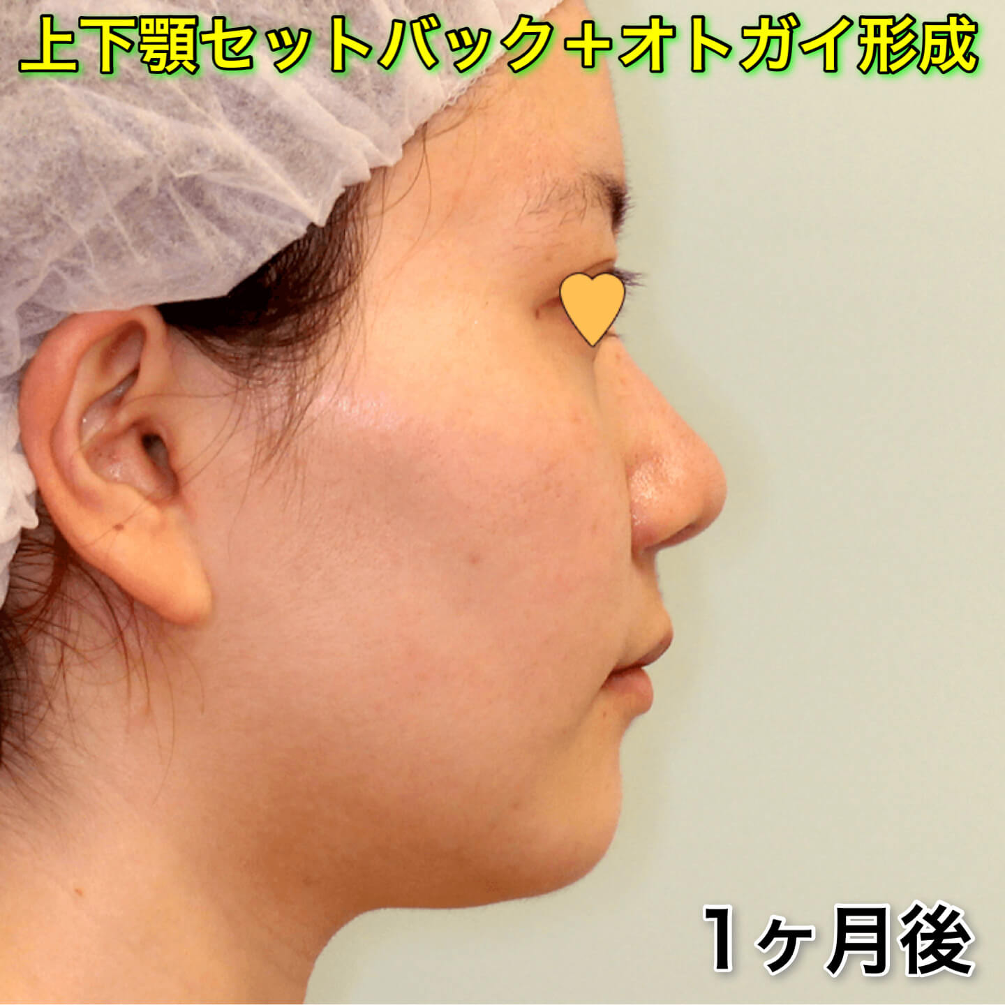 上下顎セットバック+オトガイ形成の症例写真（ビフォーアフター）