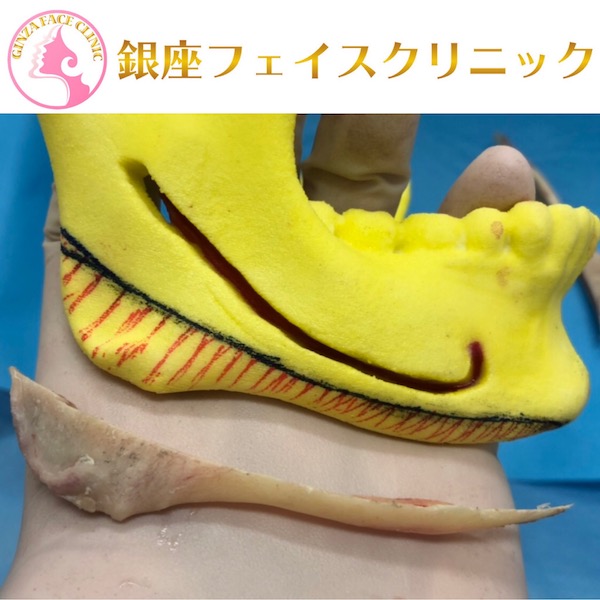 エラ削り手術の症例写真