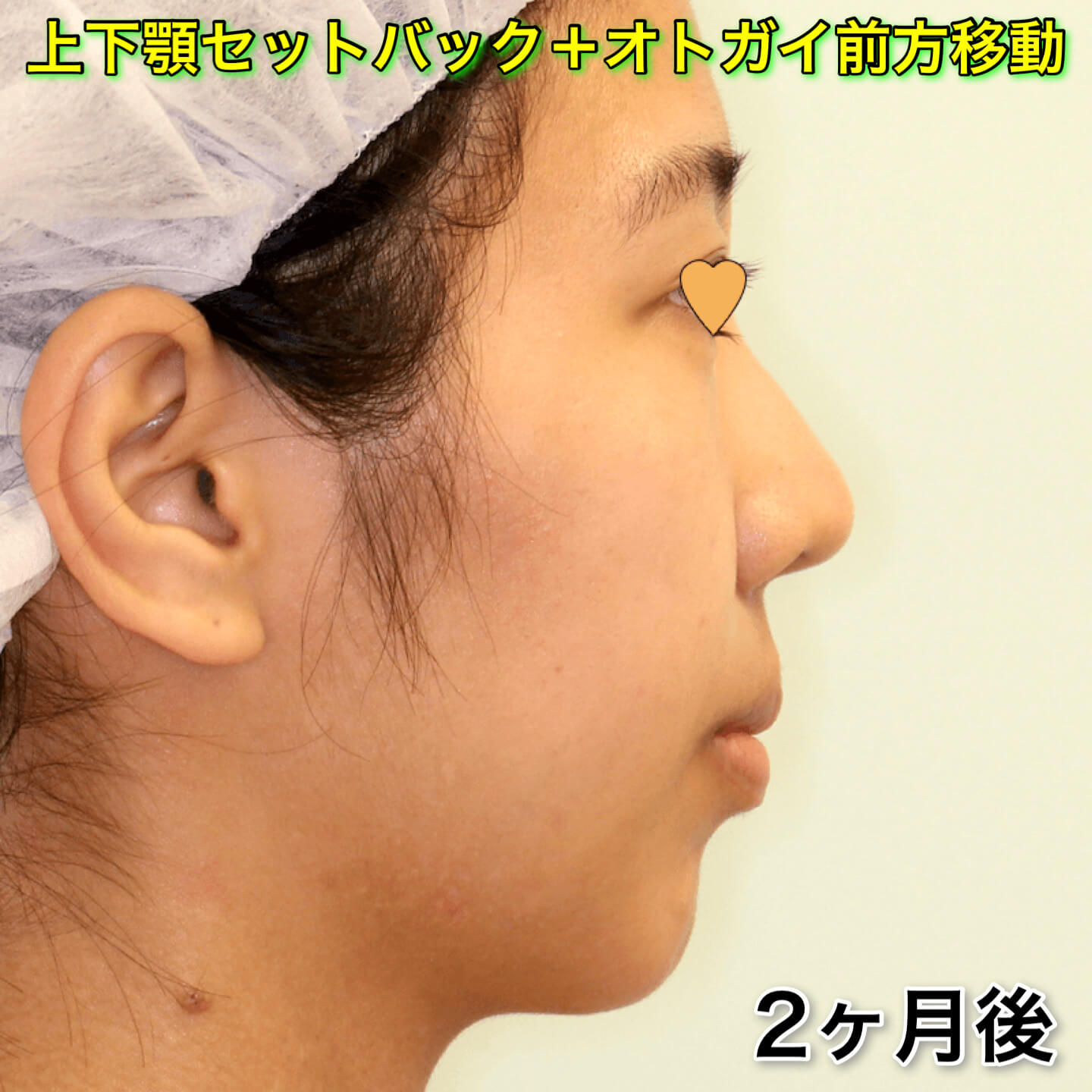 上下セットバック 口元の前突やこんもり感を治す手術 東京銀座で小顔 輪郭の美容整形するなら 銀座フェイスクリニック 小顔整形 輪郭整形専門の 美容外科 銀座フェイスクリニック