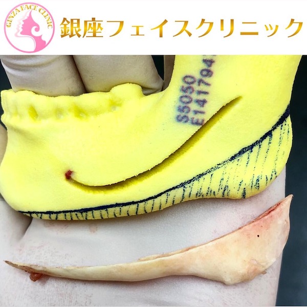 エラ削り手術の症例写真