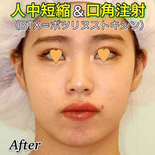 人中短縮ボトックス｜口角ボトックスの症例写真ビフォーアフター