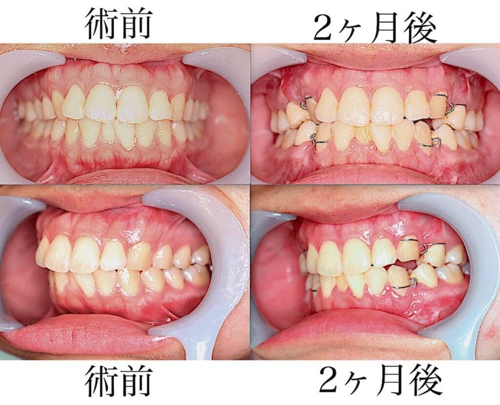 上下顎セットバック｜術後の口腔内（歯）の様子