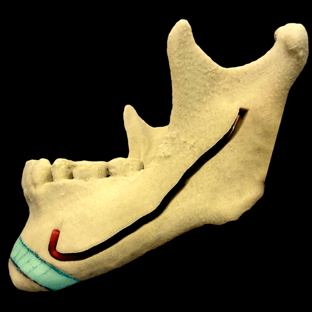 オトガイ形成（逆V字骨切り/中抜き）の3D骨格模型でのデザイン