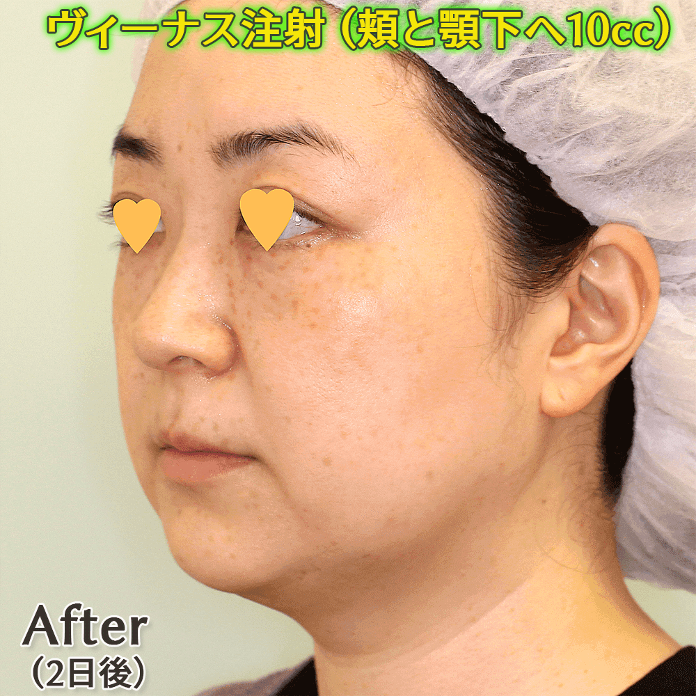 ヴィーナス注射（脂肪溶解注射）の症例写真ビフォーアフター