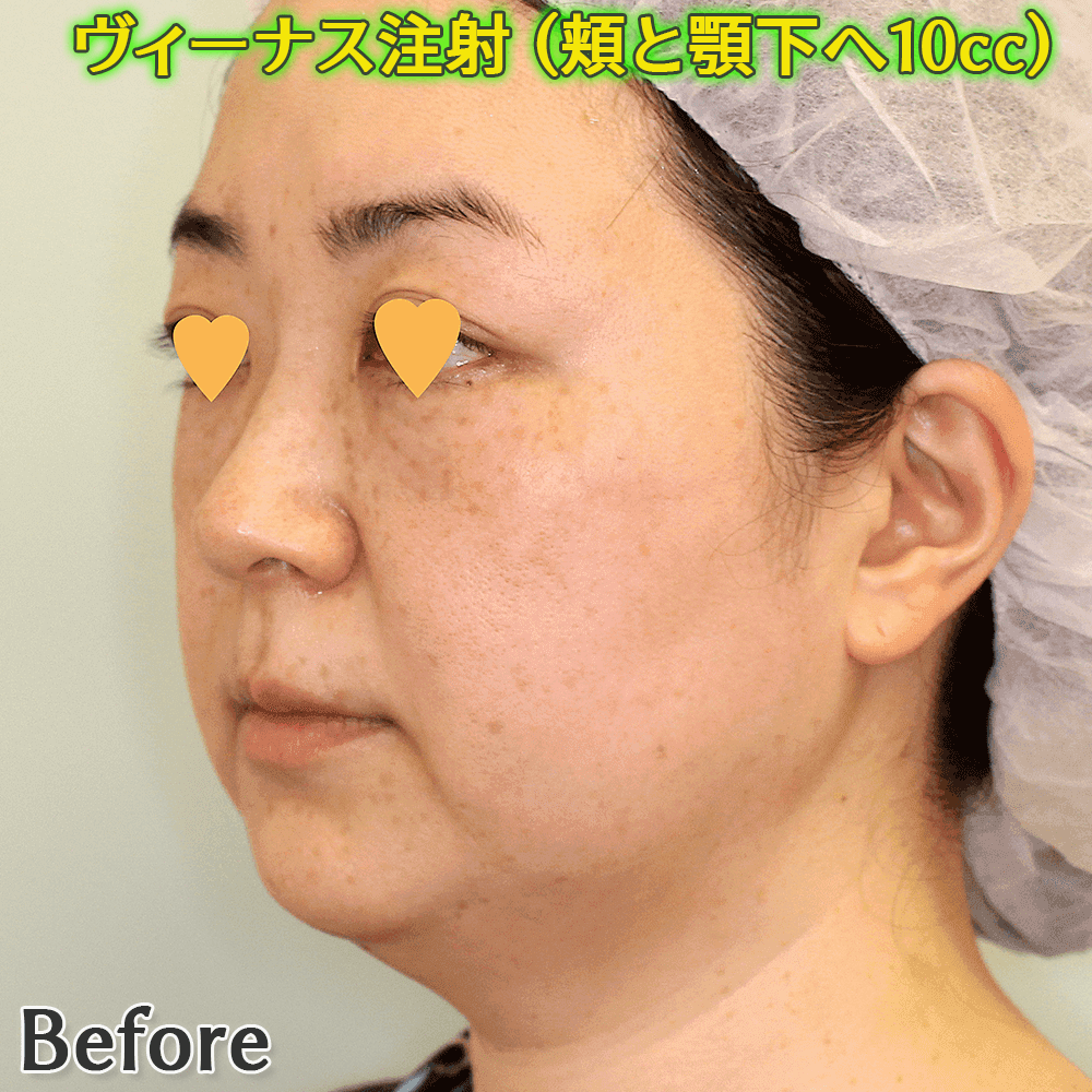 ヴィーナス注射（脂肪溶解注射）の症例写真ビフォーアフター