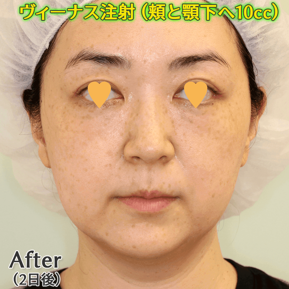 ヴィーナス注射（脂肪溶解注射）の症例写真ビフォーアフター
