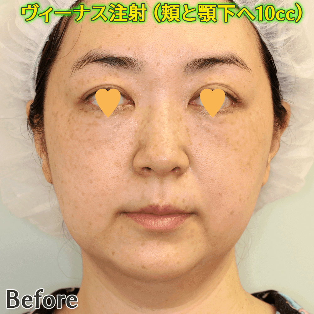 ヴィーナス注射（脂肪溶解注射）の症例写真ビフォーアフター