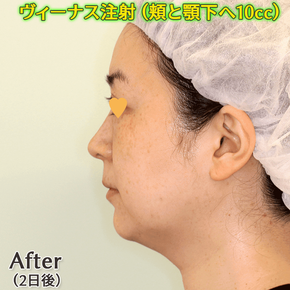 ヴィーナス注射（脂肪溶解注射）の症例写真ビフォーアフター