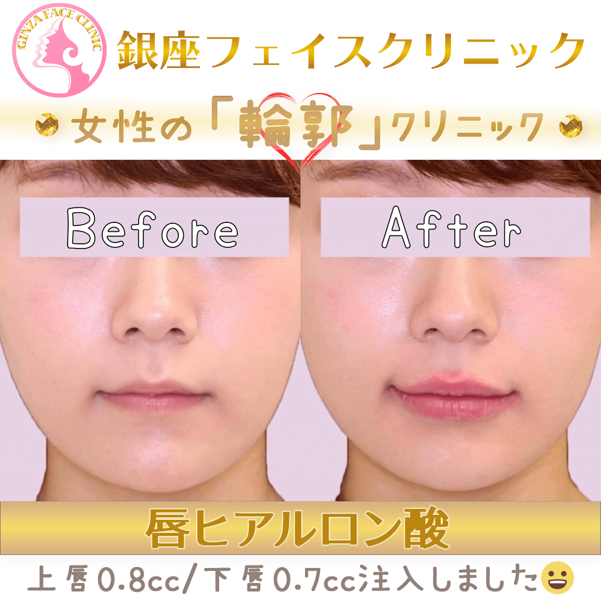 唇ヒアル ヒアルロン酸注入による唇形成 小顔整形 輪郭整形専門の美容外科 銀座フェイスクリニック