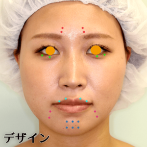 中顔面短縮注射の症例写真ビフォーアフター