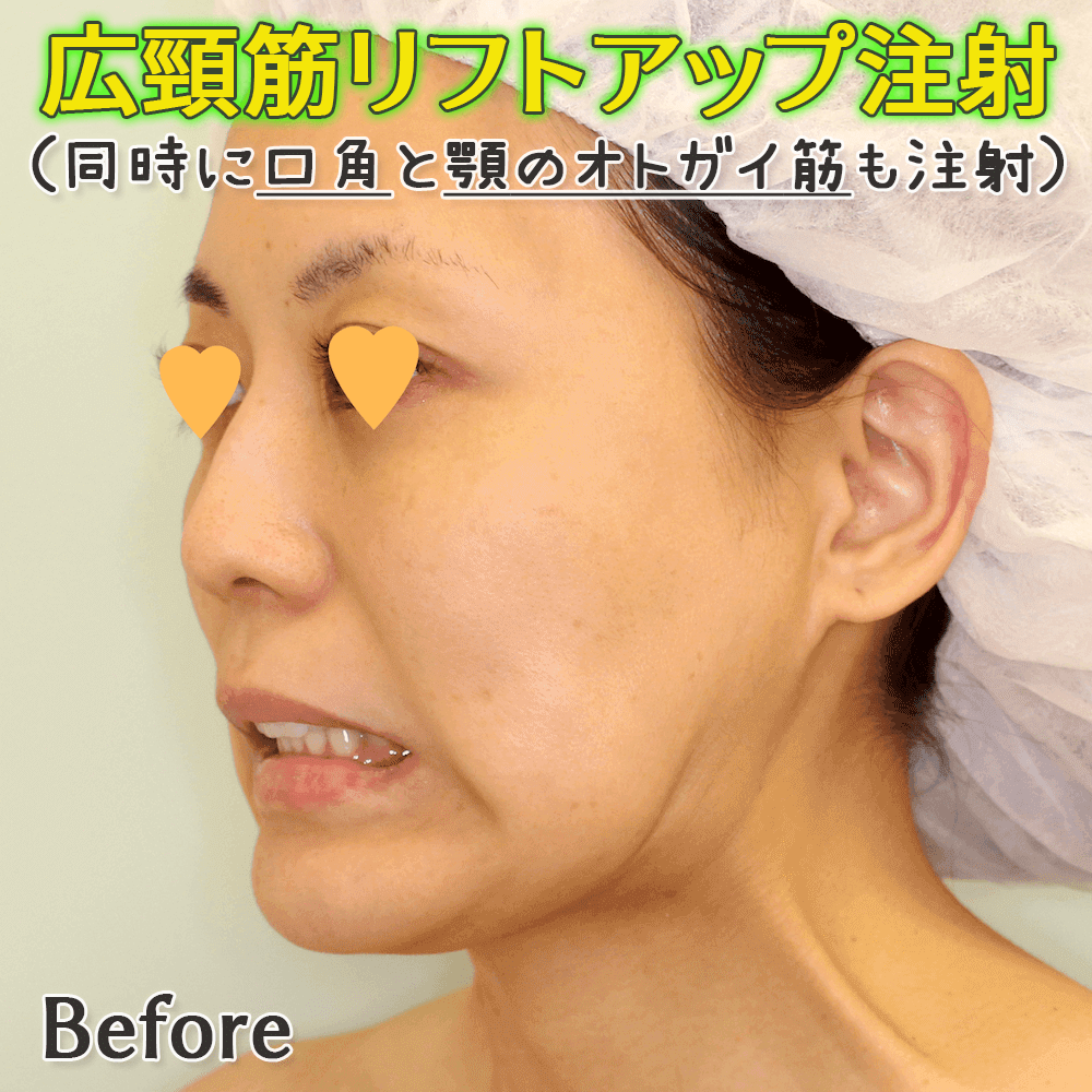 イノトックス（世界初の液体型ボツリヌストキシン製剤） | 小顔