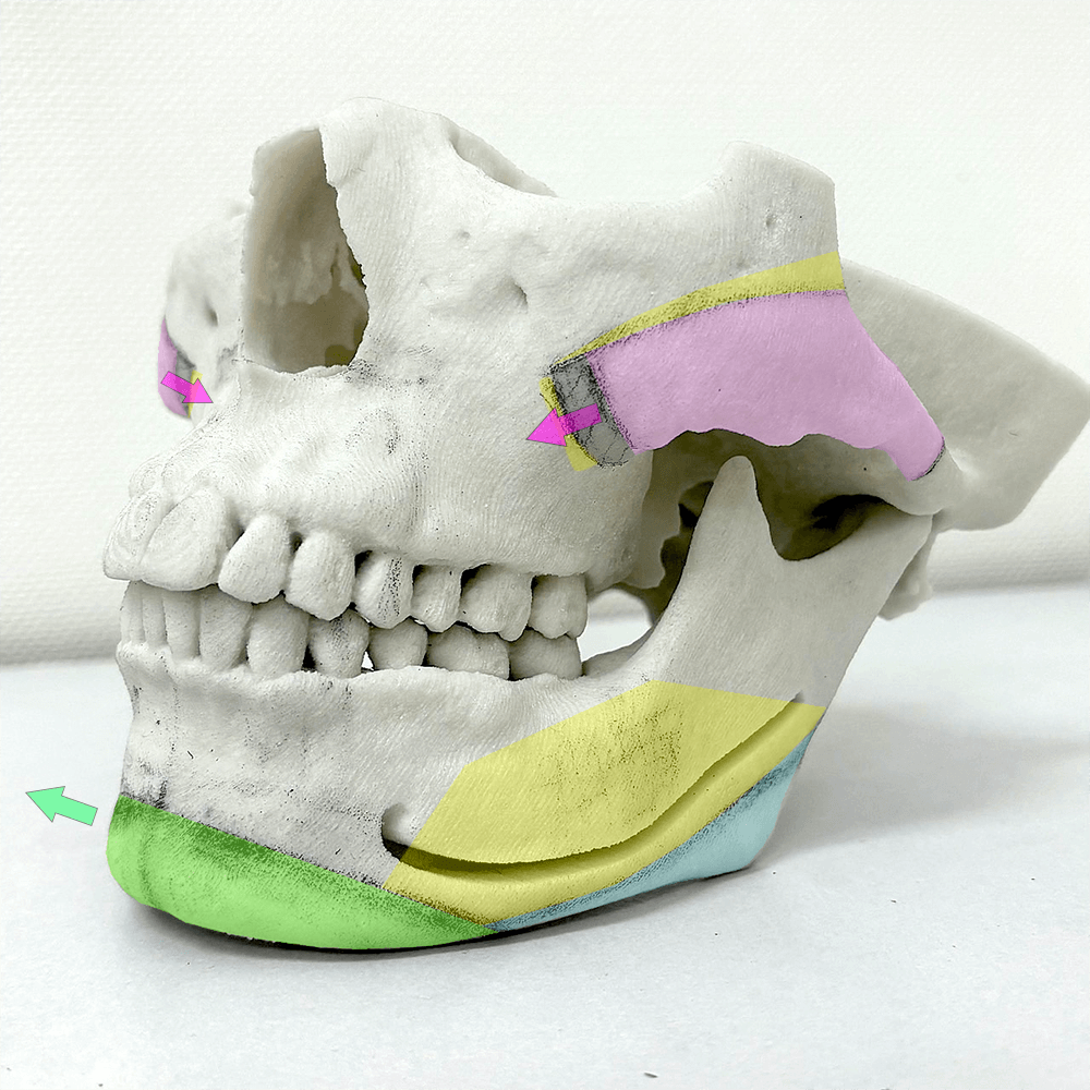 輪郭三点（輪郭3点）手術のデザイン｜頬骨・エラ・オトガイの同時骨切り・骨削り