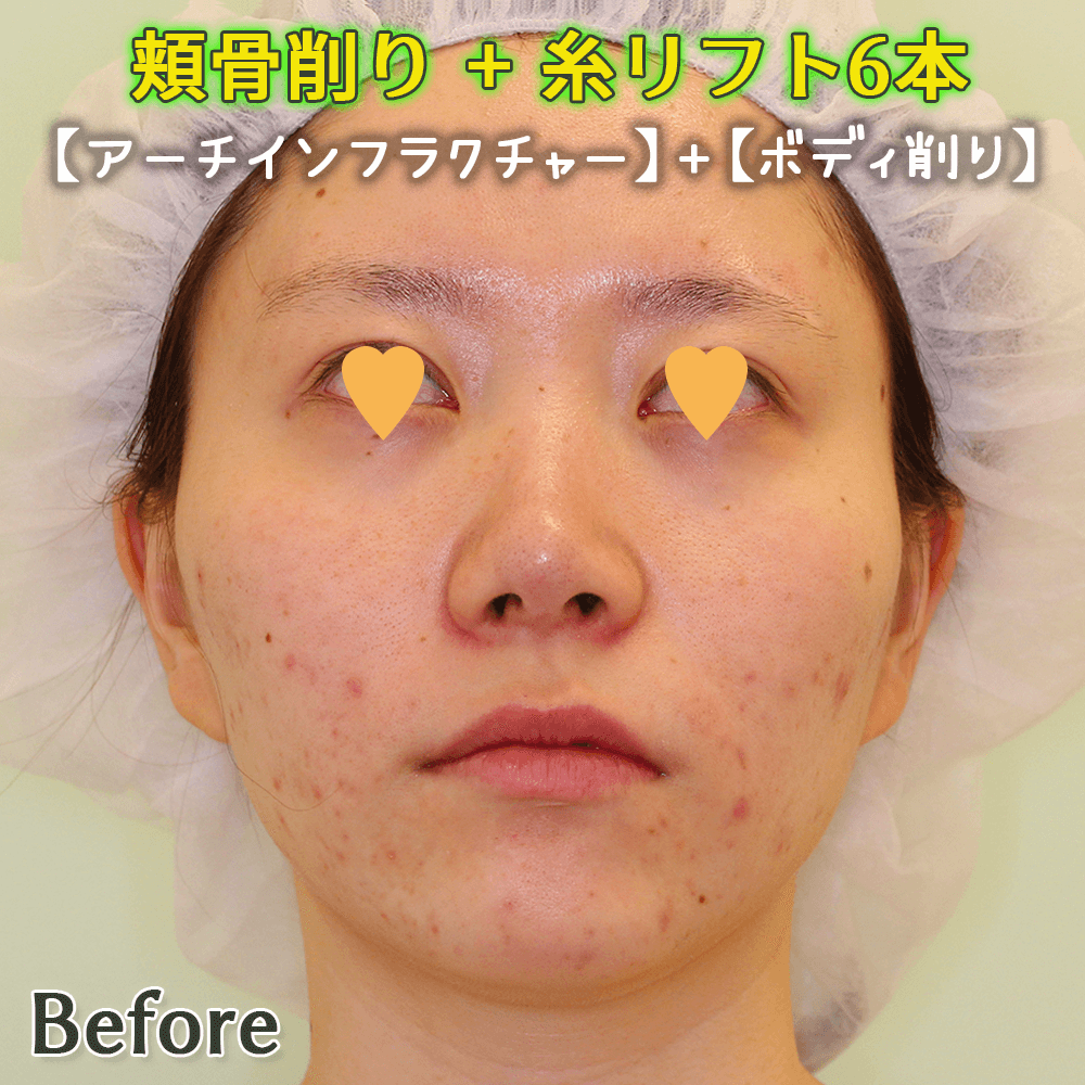 頬骨削り（アーチ・インフラクチャー+ボディ削り）のビフォーアフター症例写真｜ダウンタイム
