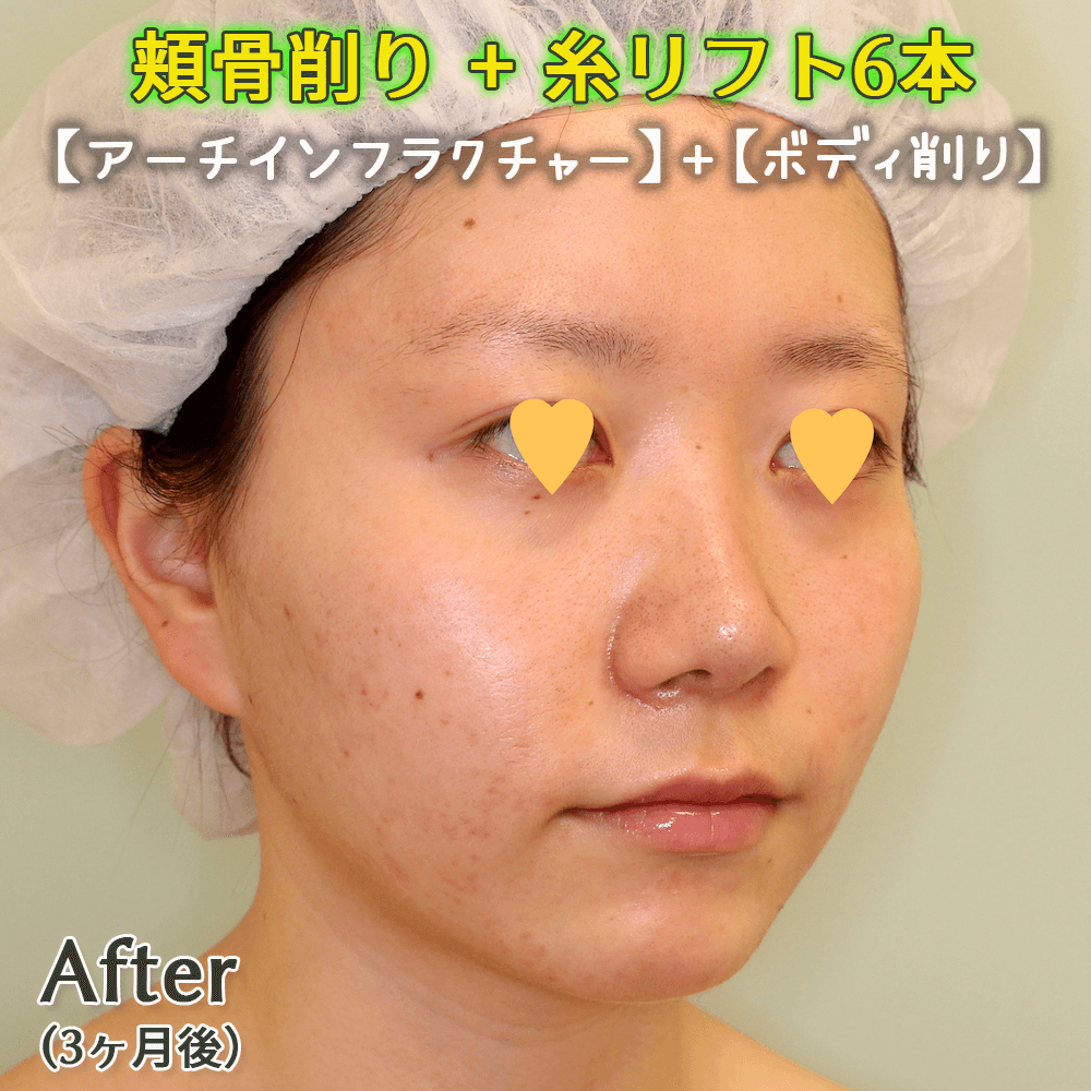 頬骨削り（アーチインフラクチャー+ボディ削り）+糸リフトのビフォーアフター症例写真