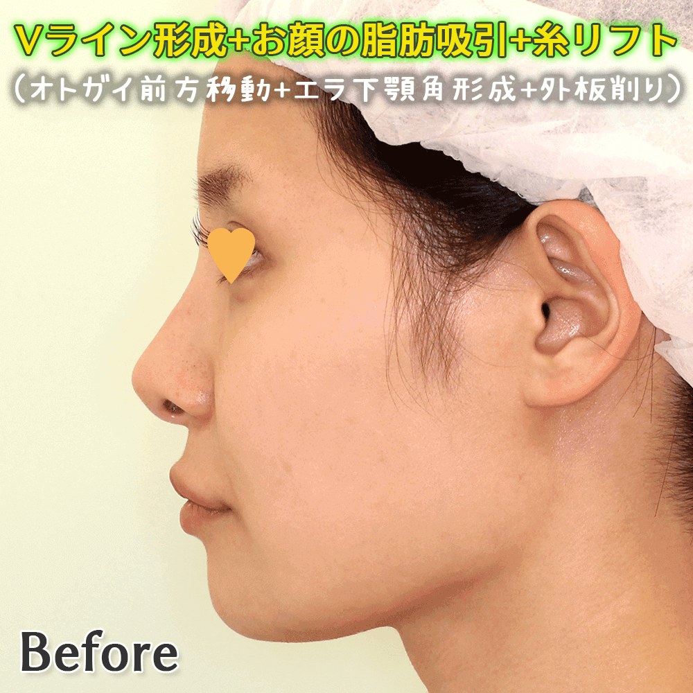 Vライン形成（オトガイ前方移動+エラ下顎角形成+外板削り）+お顔の脂肪吸引4部位+糸リフトのビフォーアフター症例写真