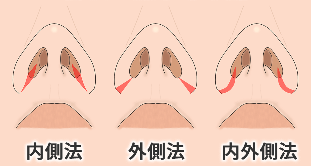 鼻翼縮小手術_3つの方法（内側法・外側法・ない外側法）