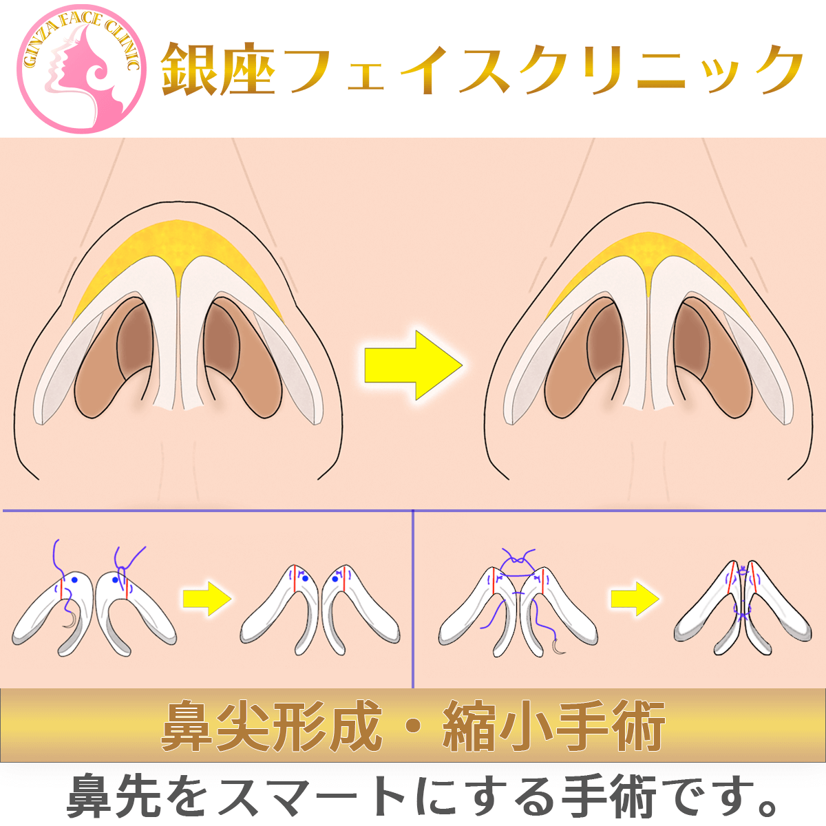 鼻尖形成縮小手術のアイキャッチ