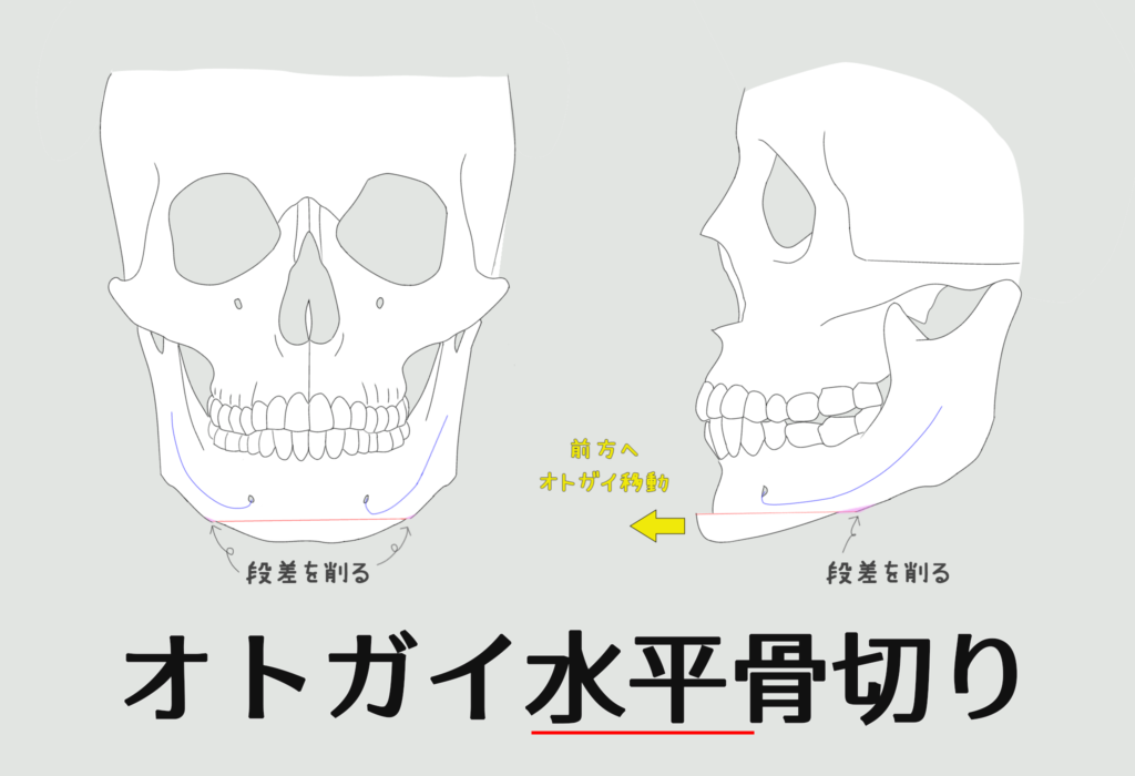 オトガイ水平骨切り