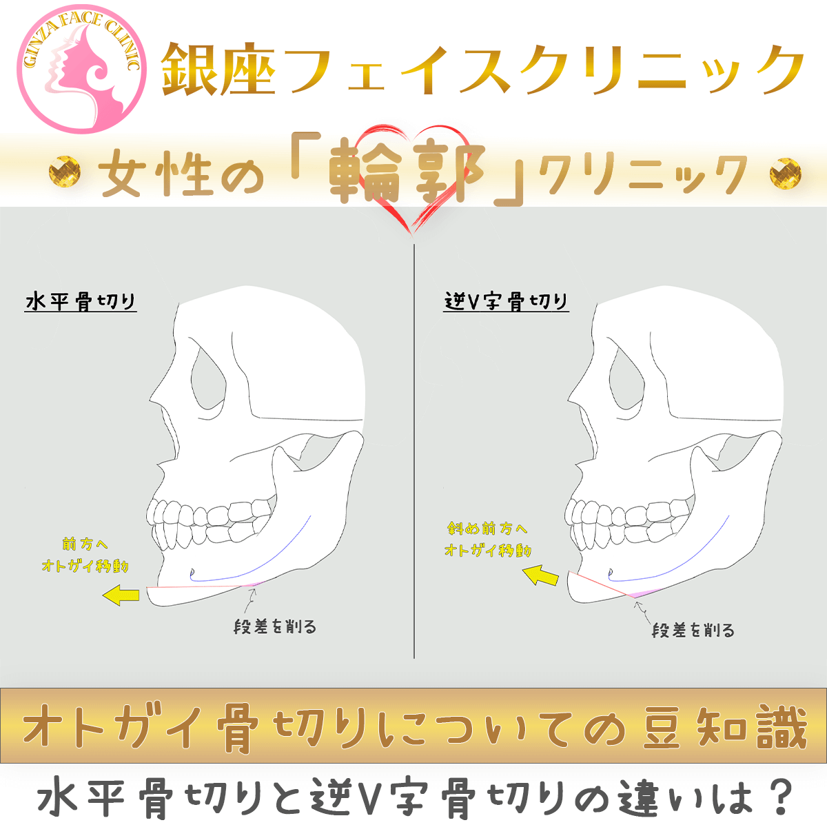 オトガイ水平骨切りと逆V字骨切りの違いとは？