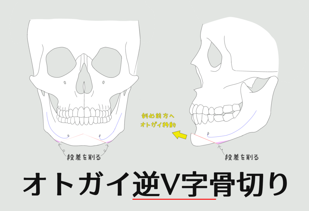 オトガイ逆V字骨切り