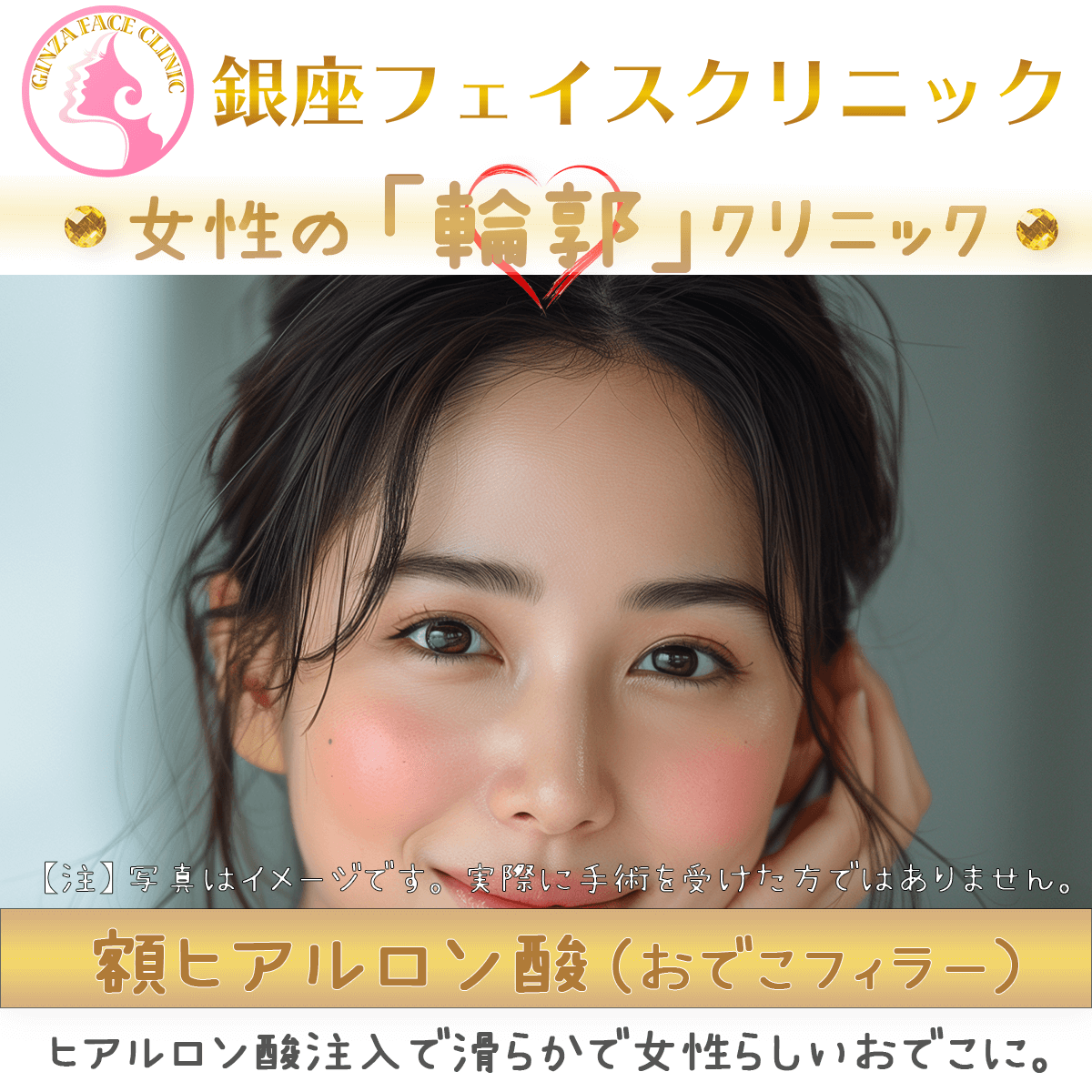 おでこフィラー（額ヒアルロン酸）