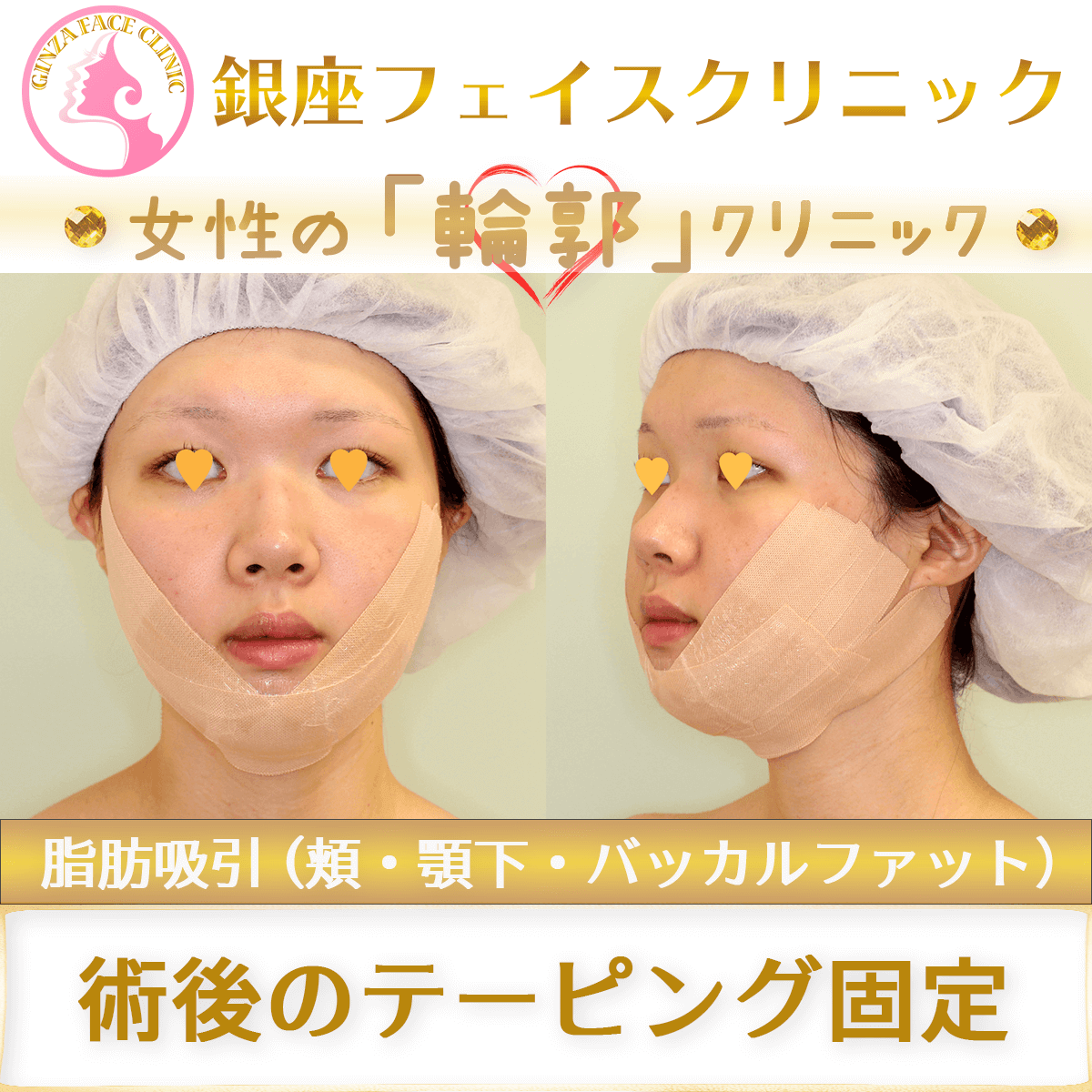 脂肪吸引手術後のテーピング固定
