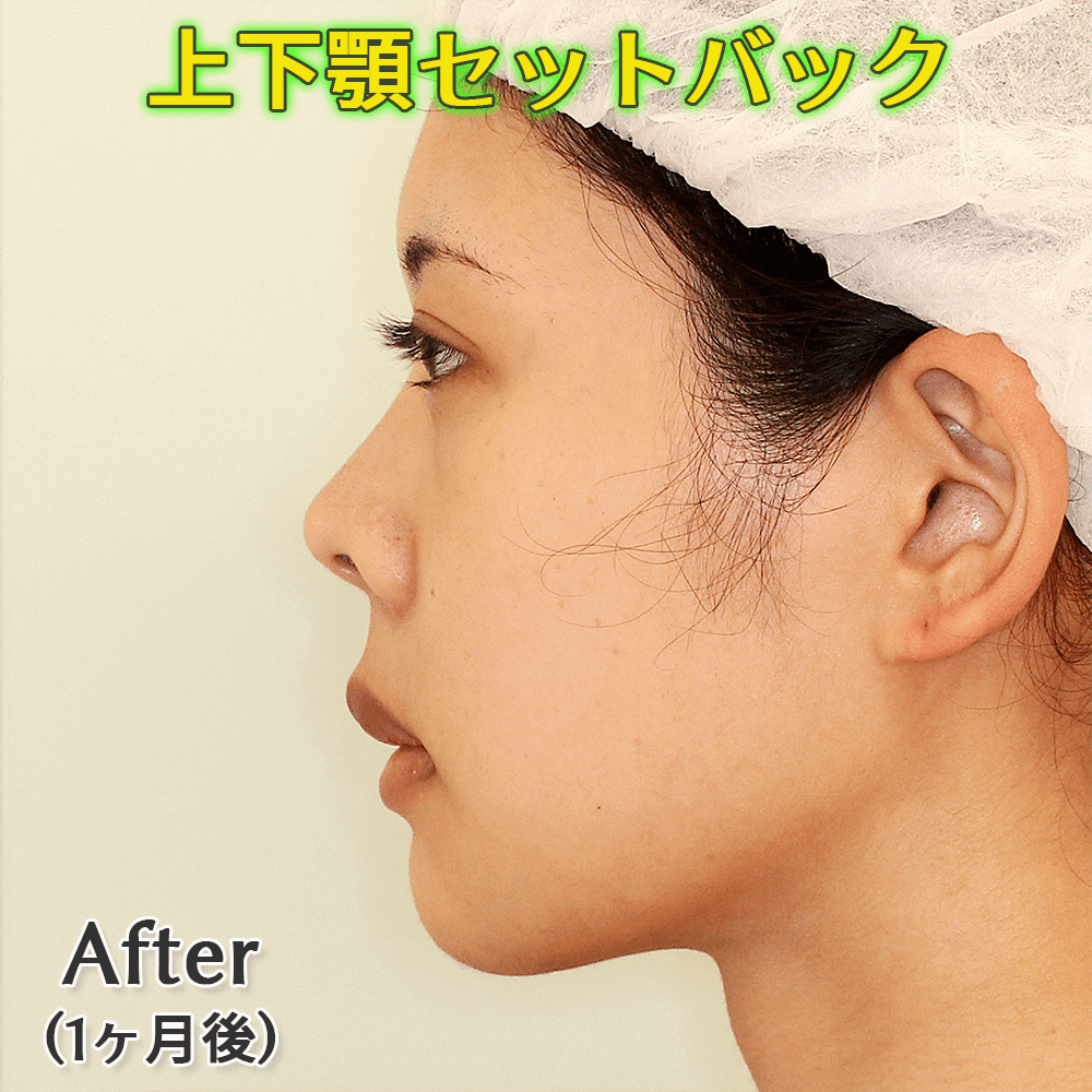 口ゴボ改善｜上下顎セットバックのビフォーアフター症例写真