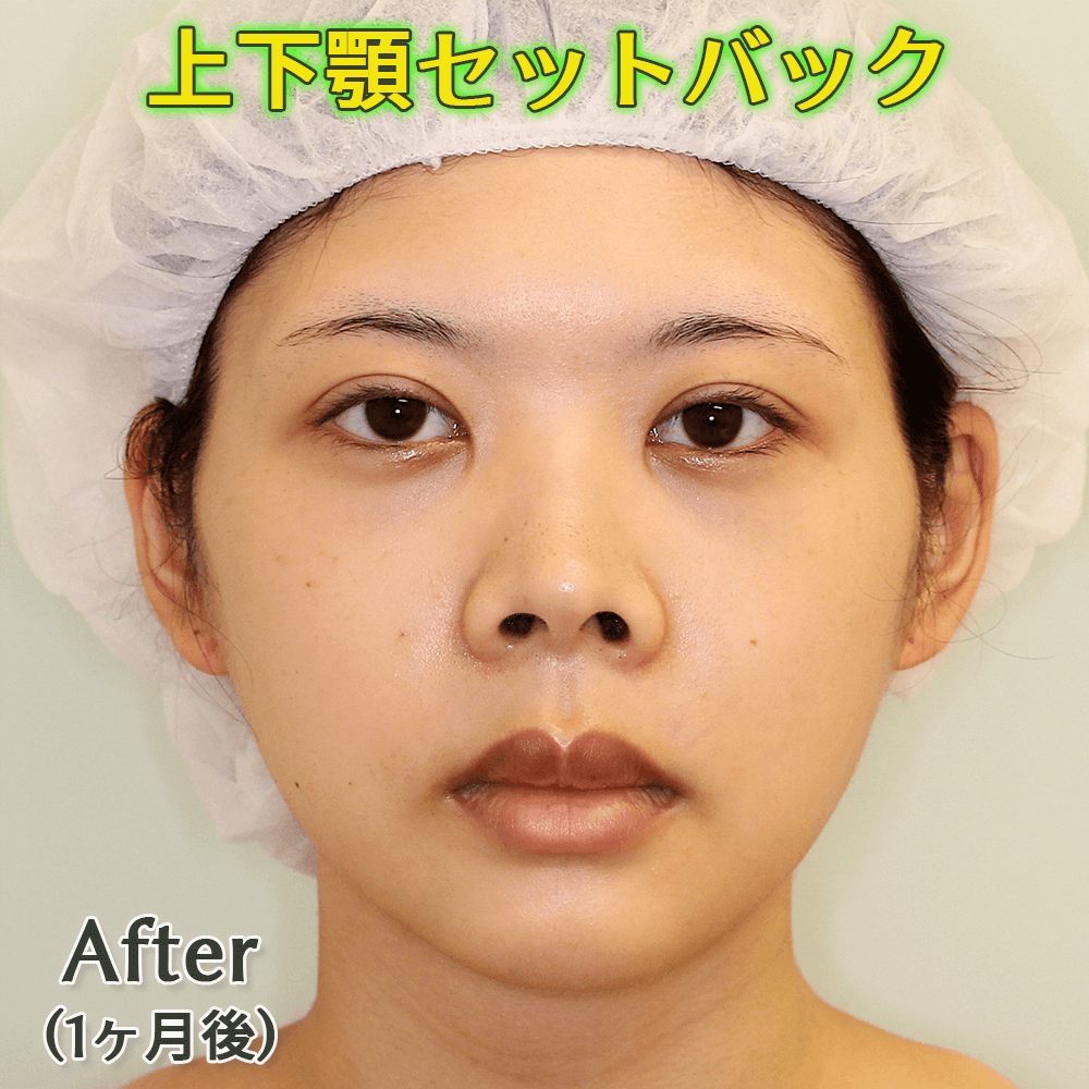 口ゴボ改善｜上下顎セットバックのビフォーアフター症例写真