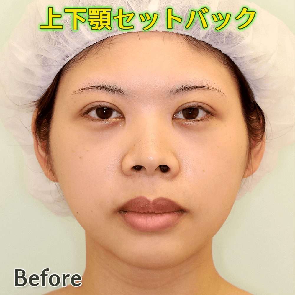 口ゴボ改善｜上下顎セットバックのビフォーアフター症例写真