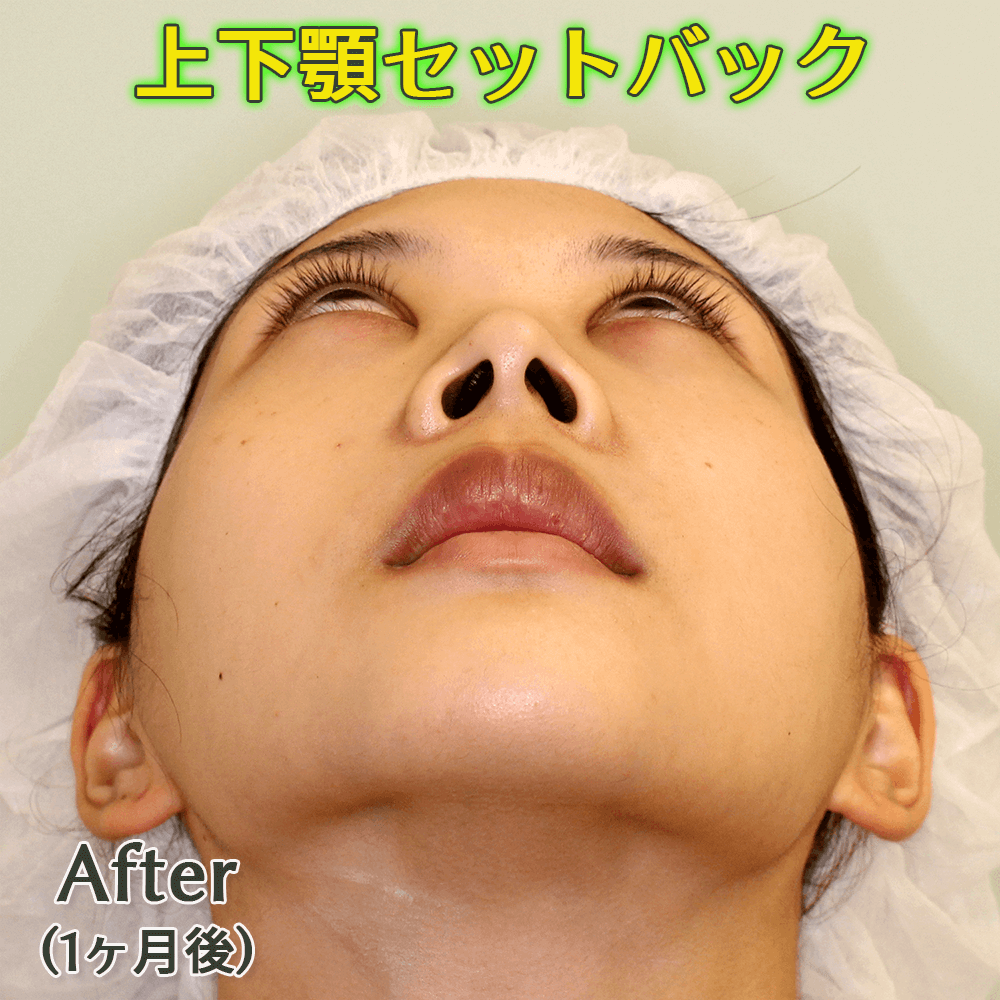 口ゴボ改善｜上下顎セットバックのビフォーアフター症例写真