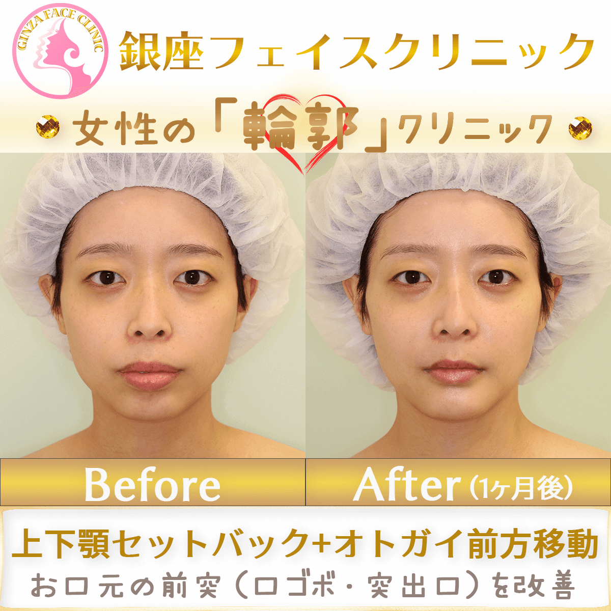 上下顎セットバック+オトガイ｜ビフォーアフター症例写真｜1ヶ月後