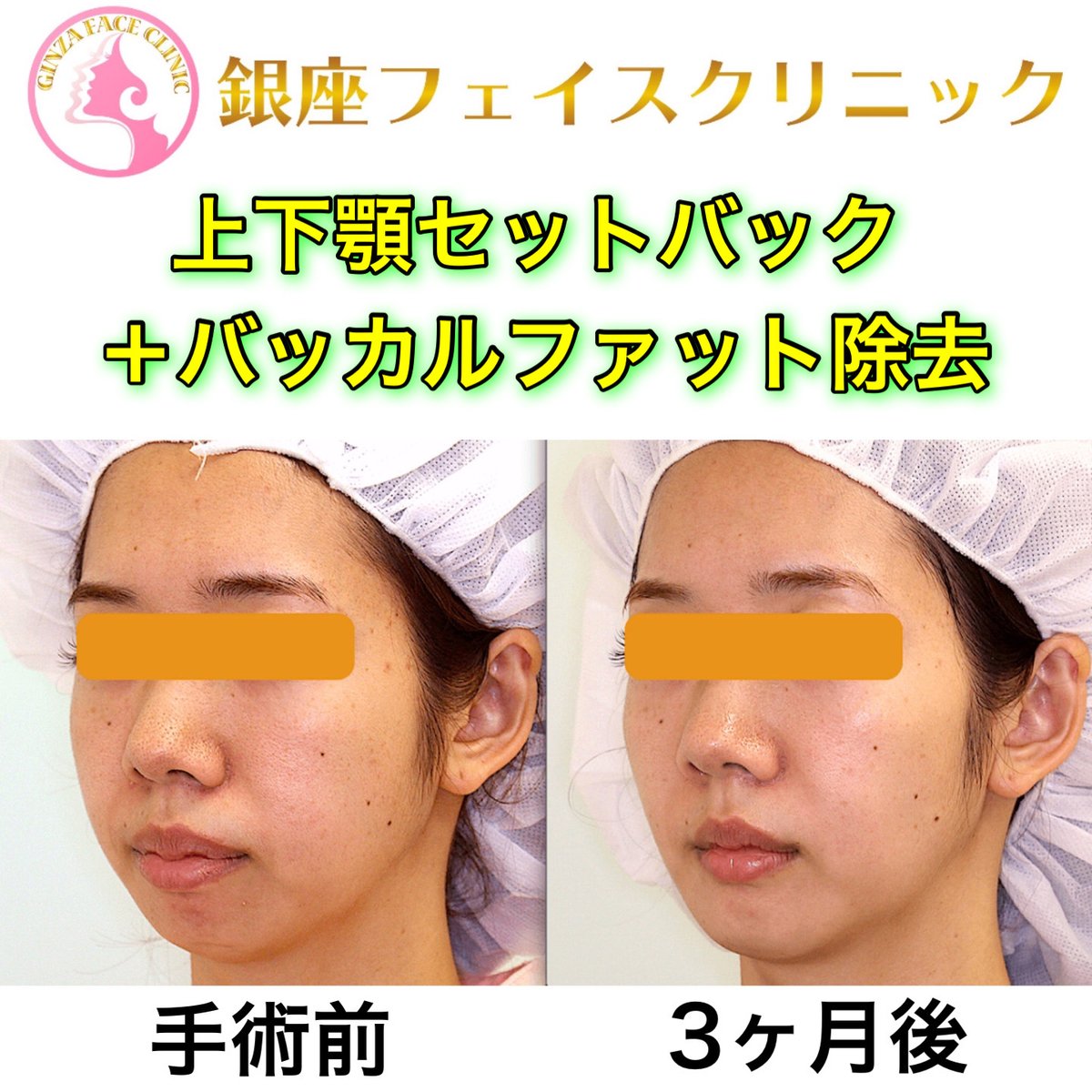 口ゴボを改善する上下顎セットバックのビフォーアフター症例写真｜銀座フェイスクリニック