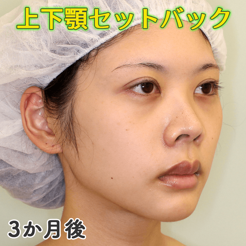 口ゴボ改善する上下顎セットバック手術の症例写真｜腫れの経過