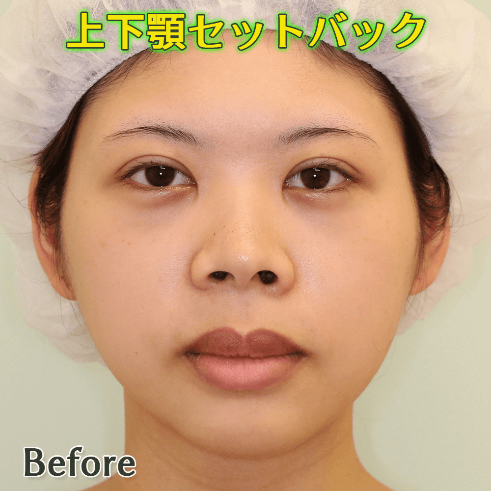 口ゴボ改善する上下顎セットバック手術のビフォーアフター症例写真