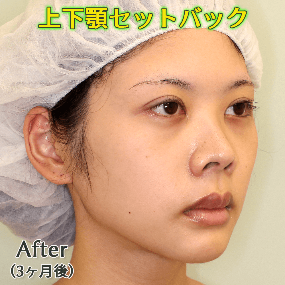 口ゴボ改善する上下顎セットバック手術のビフォーアフター症例写真