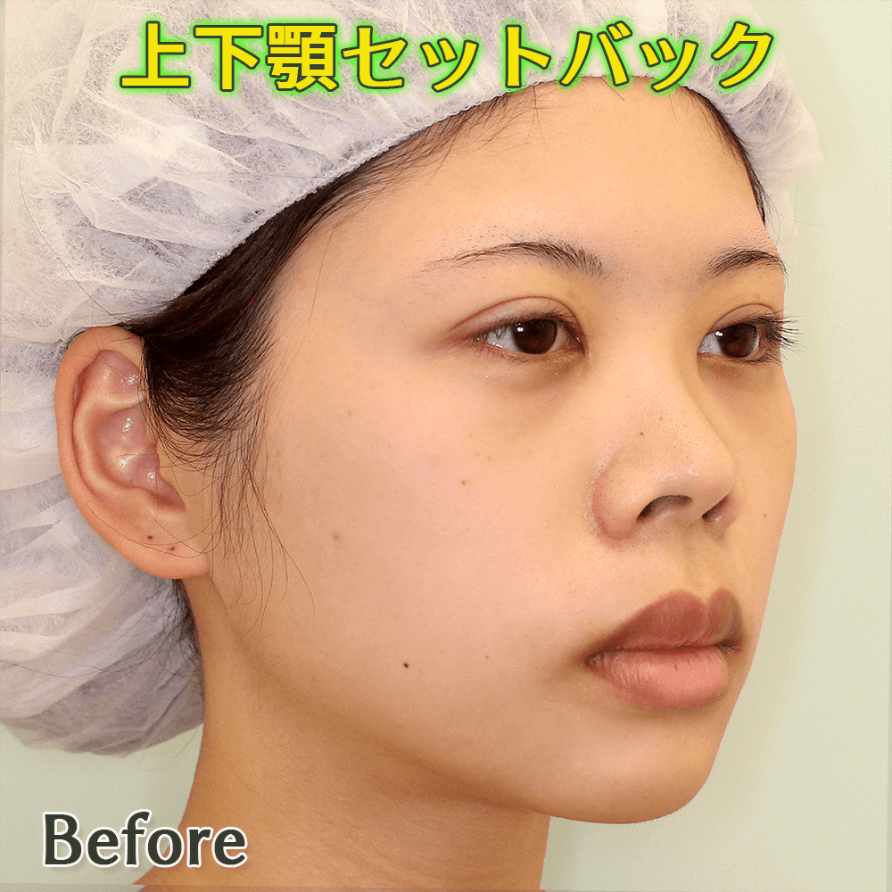 口ゴボ改善する上下顎セットバック手術のビフォーアフター症例写真