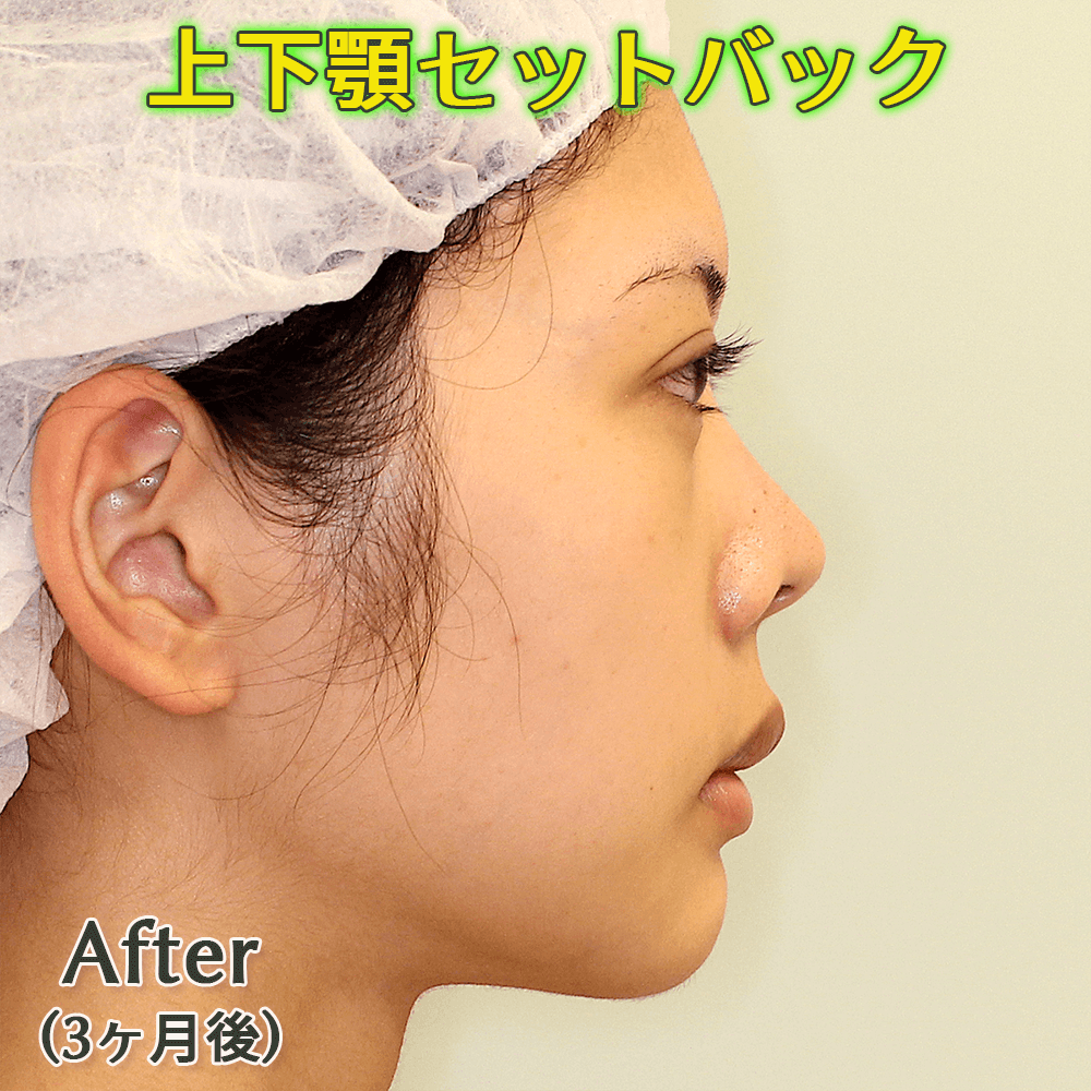 口ゴボ改善する上下顎セットバック手術のビフォーアフター症例写真