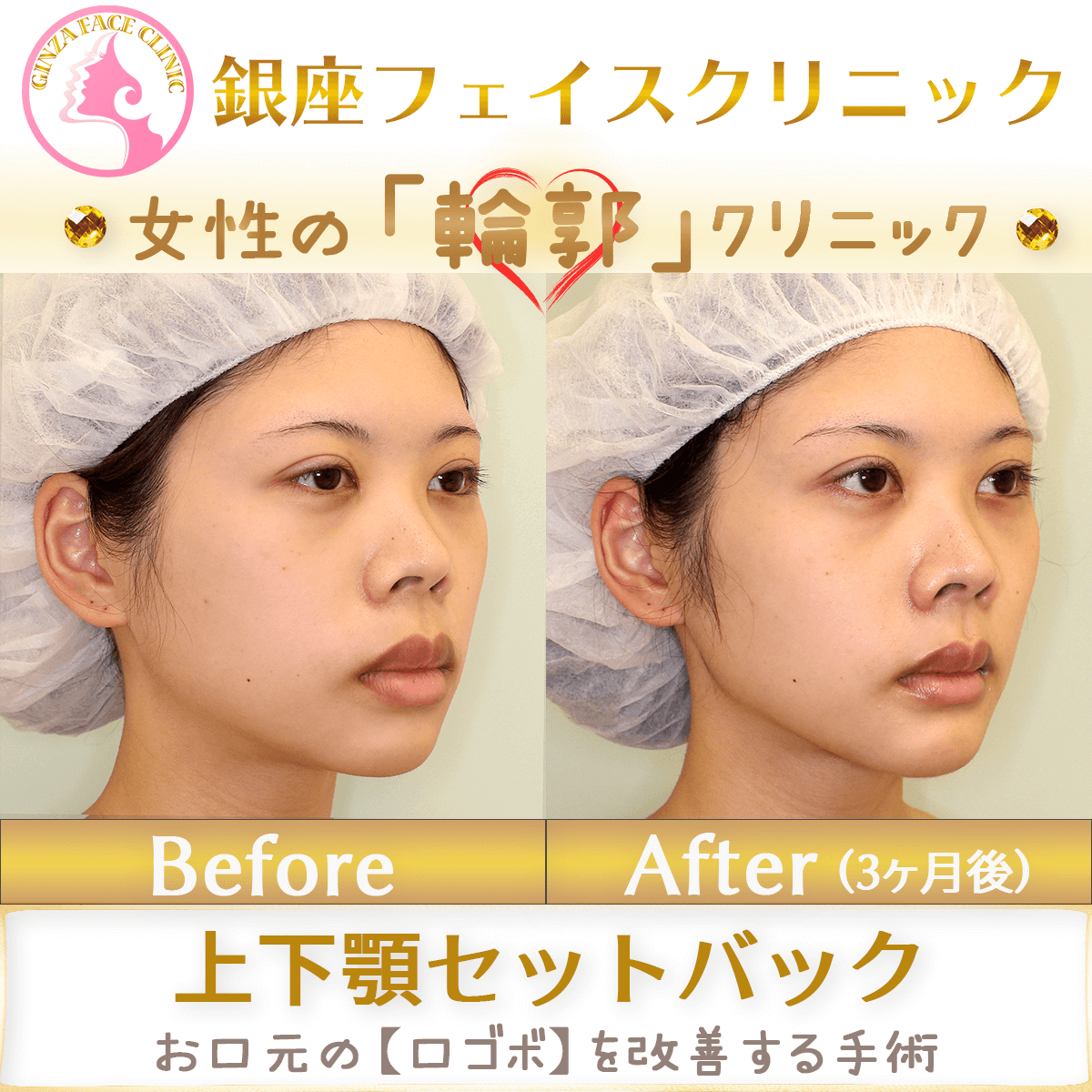 口ゴボ改善する上下顎セットバック手術のビフォーアフター症例写真