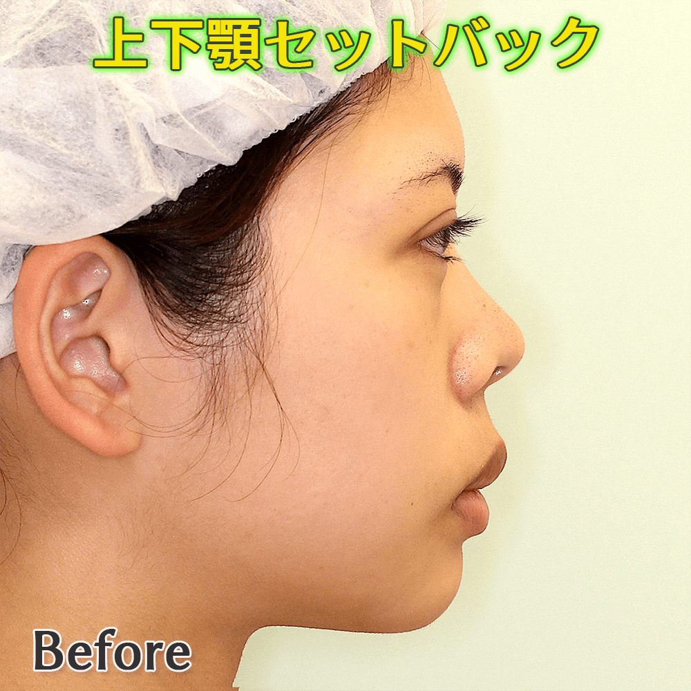 口ゴボ改善する上下顎セットバック手術のビフォーアフター症例写真