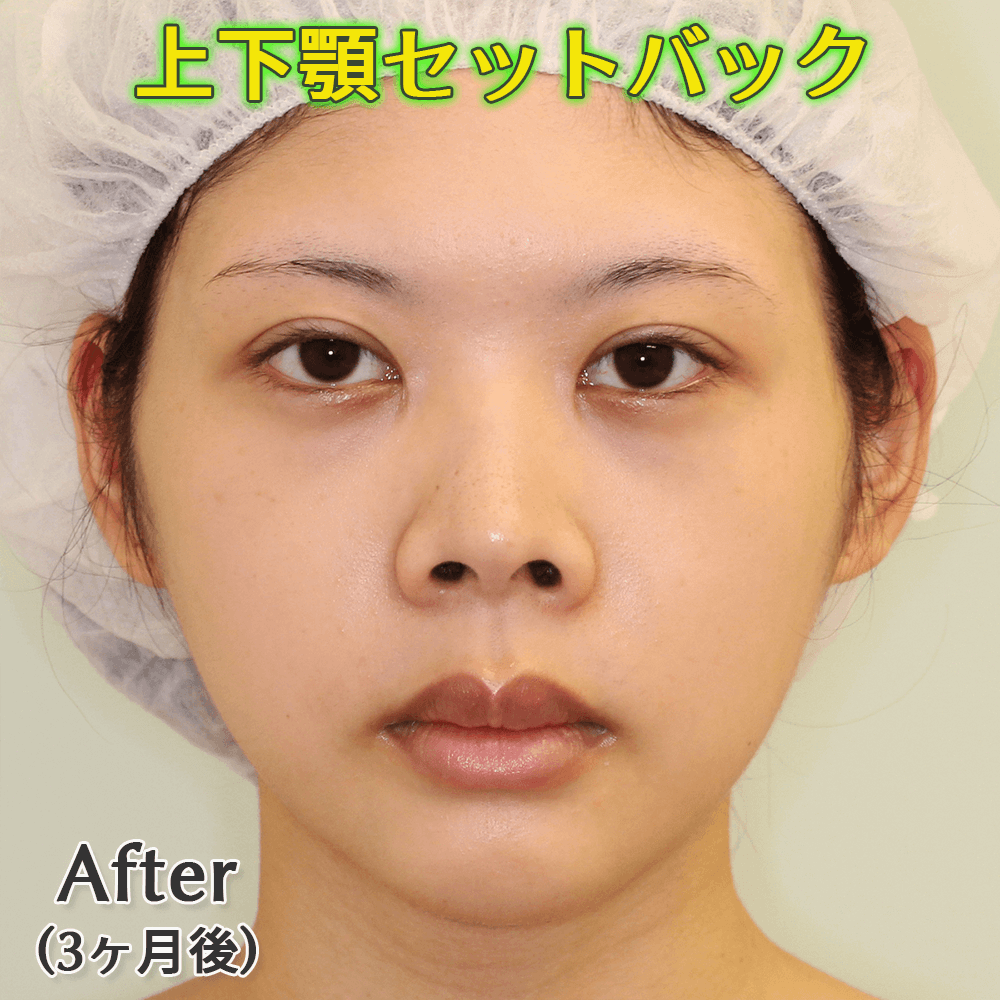 口ゴボ改善する上下顎セットバック手術のビフォーアフター症例写真