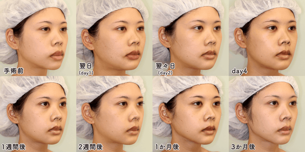 口ゴボを改善する上下顎セットバックの腫れの経過｜術後3ヶ月間の症例写真