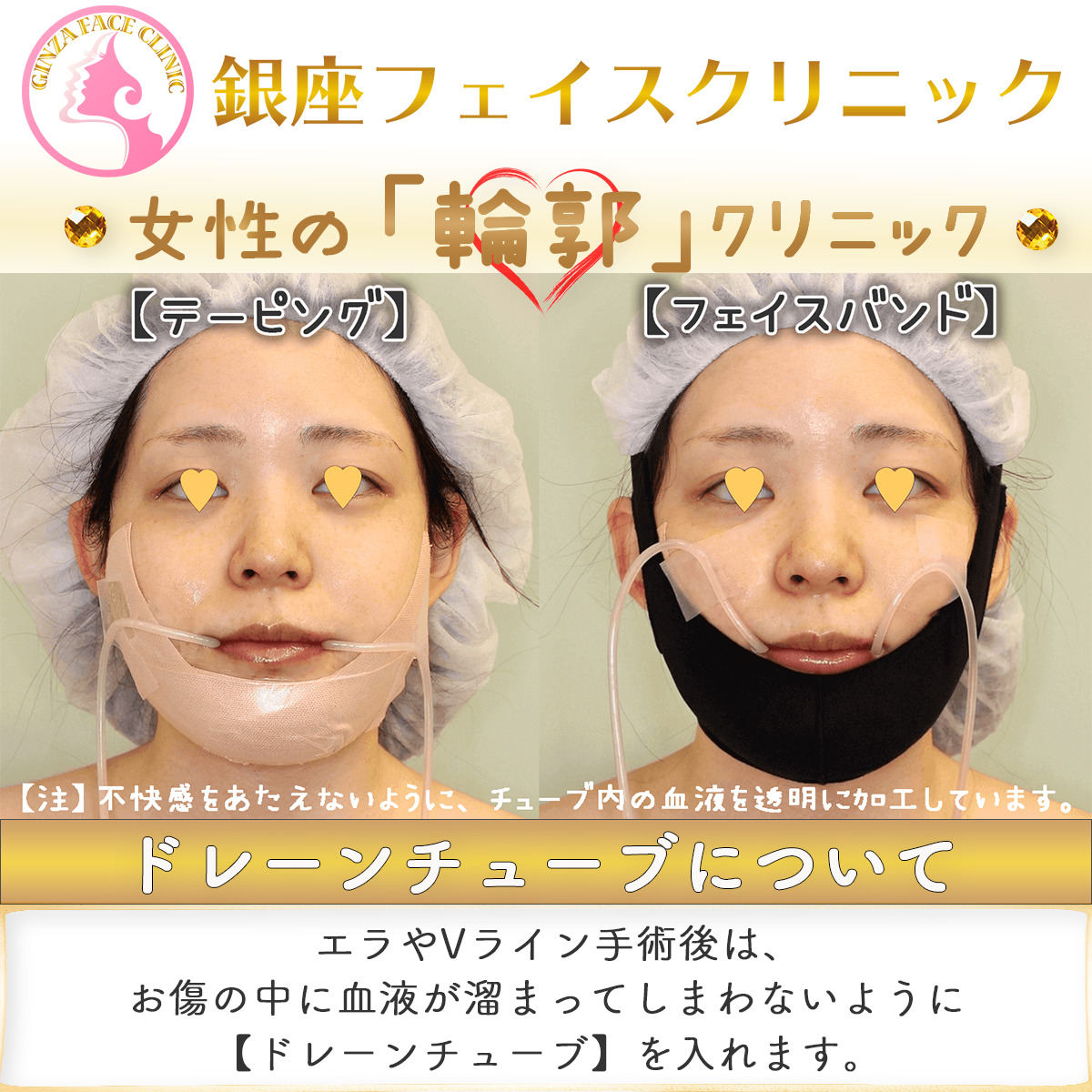 エラやVライン手術後のドレーンの様子