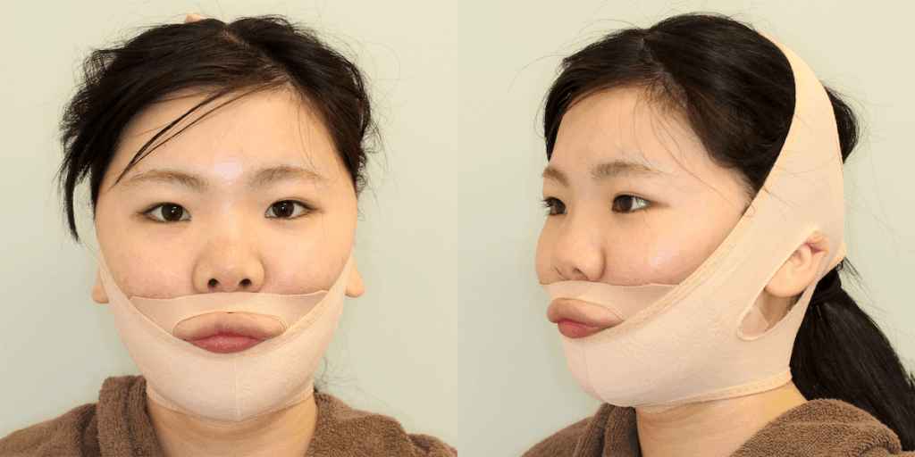 上下顎セットバック手術後のフェイスバンド固定