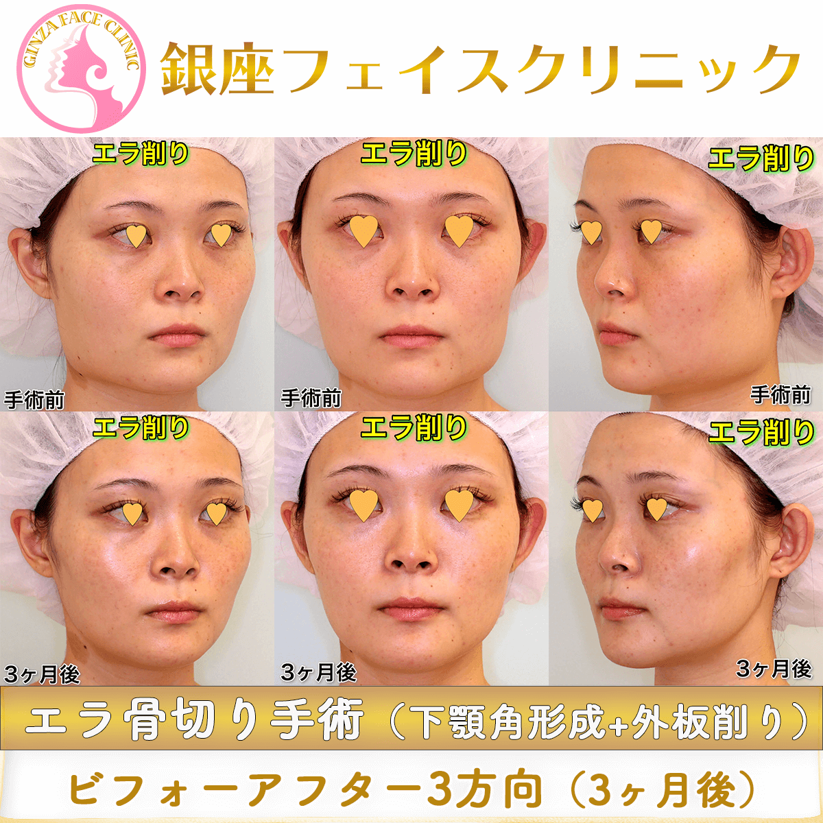エラ骨切り（下顎角形成＋外板削り）3ヶ月後のビフォーアフター｜正面・斜めから見たフェイスラインの変化