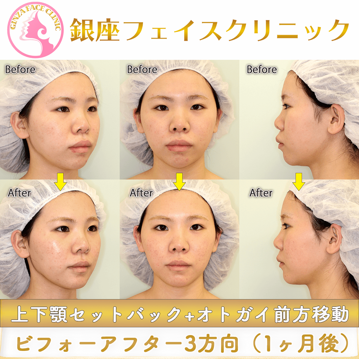 上下顎セットバック+オトガイ形成のビフォーアフター症例写真