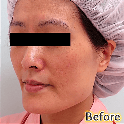 40代後半でのVライン形成の症例写真_3方向