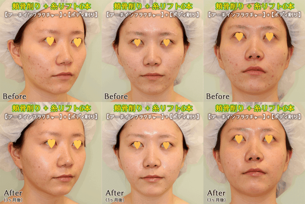 頬骨削り 糸リフト 3ヶ月後 症例写真 銀座フェイスクリニック